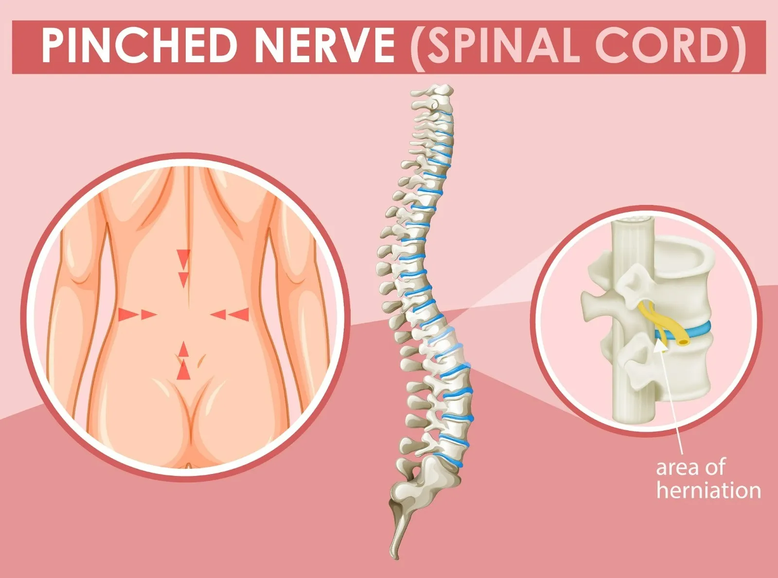 What Causes a Pinched Nerve & How Chiropractic Can Help
