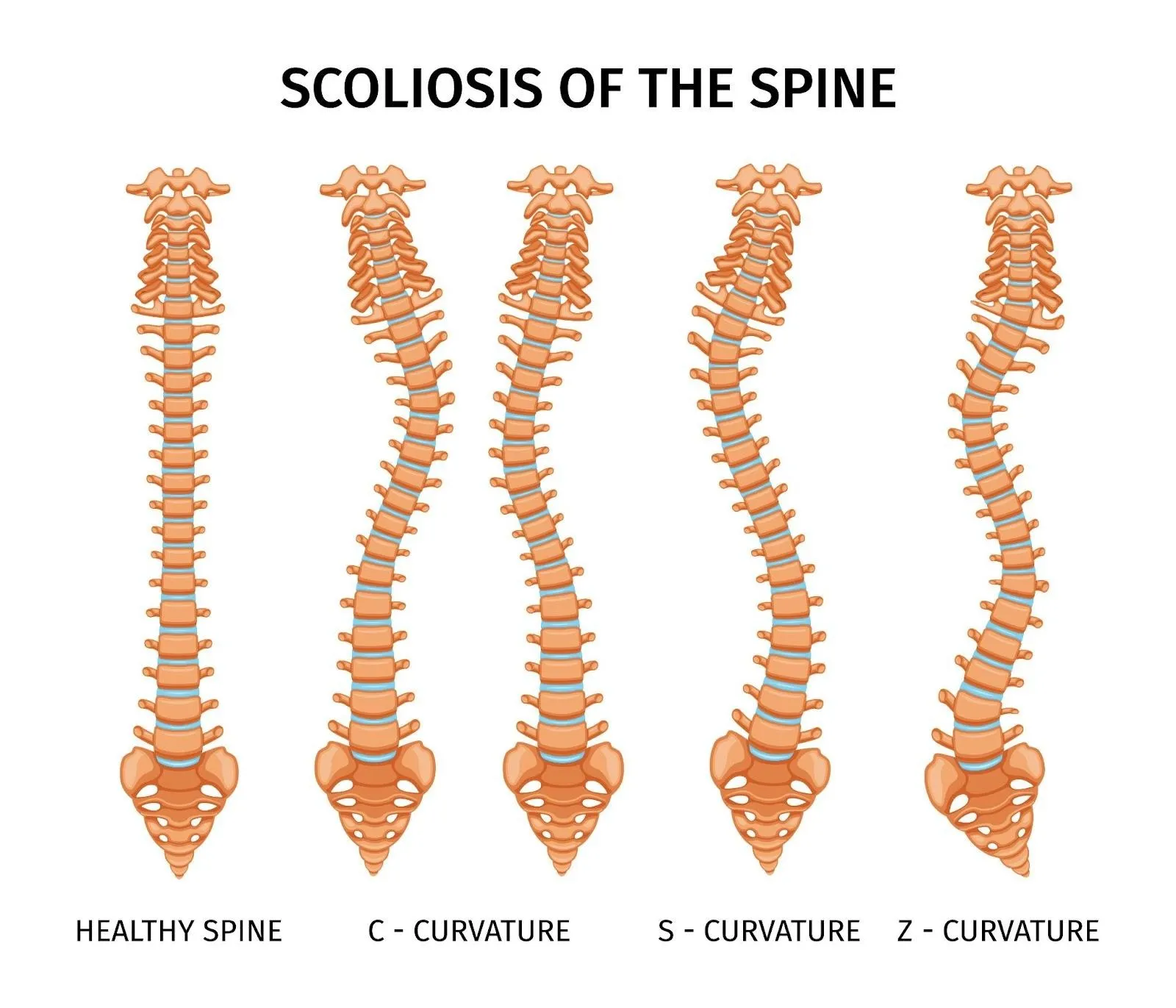 What Is Scoliosis and Safe Treatment Options